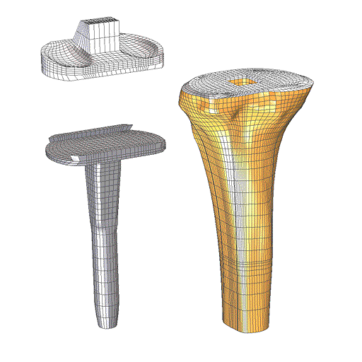 TrueGrid® Mesh of Upper Tibia 1 with Implant