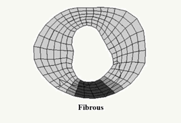 Incorporation of a Left Ventricle FEM Defining Infarction Into the XCAT Imaging Phantom